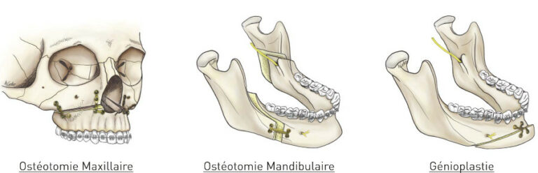 guide-de-la-chirurgie-orthognathique-tout-savoir-sur-la-chirurgie-des