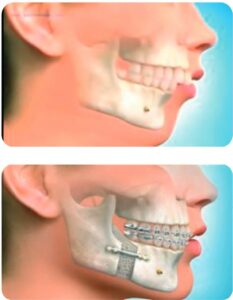 Guide de la chirurgie orthognathique – Tout savoir sur la chirurgie des ...